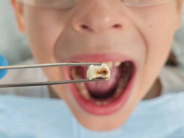 Best Knocked-Out Tooth (Avulsed Tooth) Treatment in Hwatha, IA